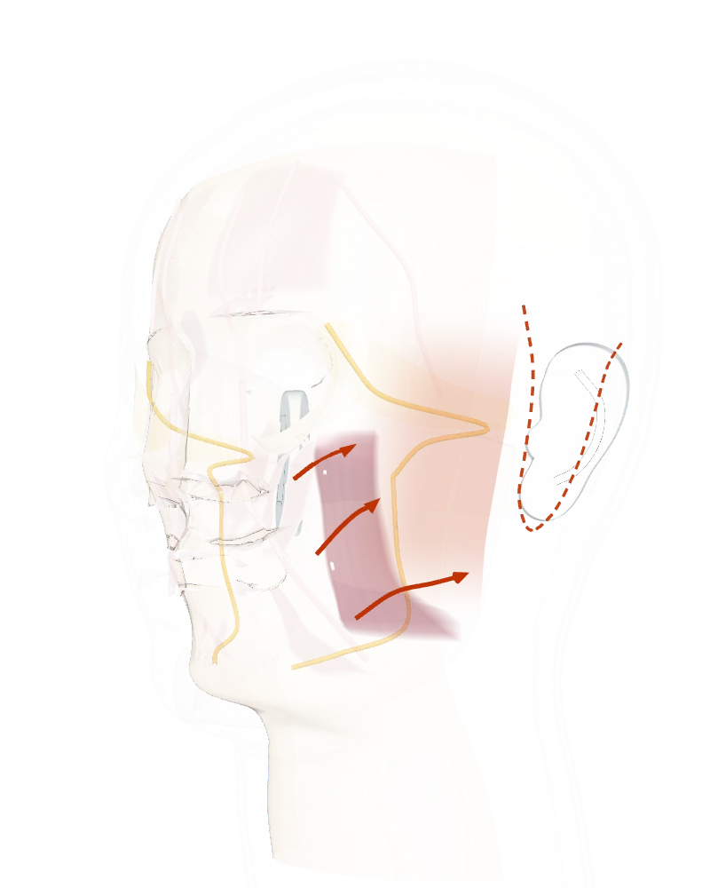 Facelift in section: arrows show the pull on the SMAS layer while the outline of the face stays the same