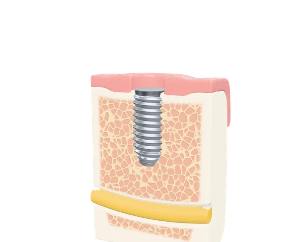 A step of the implant animation: the screw is turned into the healed jaw bone