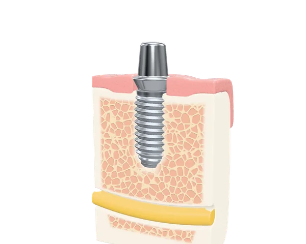 Auf dem eingeheilten Implantat sitzt ein Aufbau, der durch das Zahnfleisch reicht.